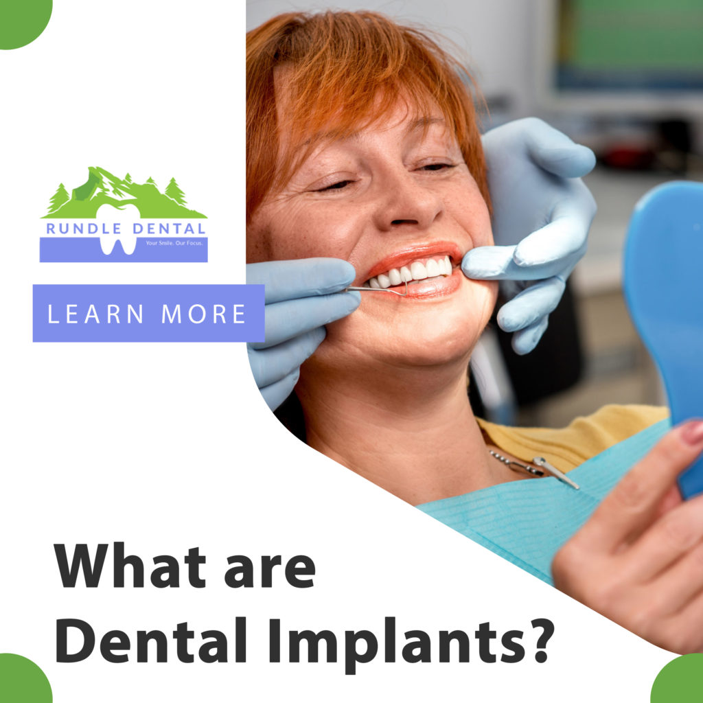 What are dental implants? — Rundle Dental Blog | General & Family ...