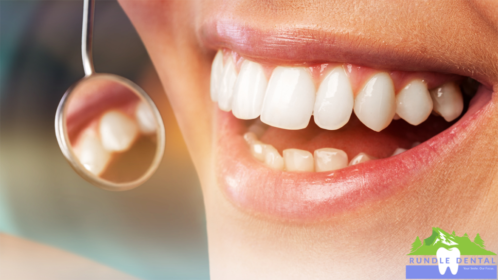 A dental mirror being held up to a smile.