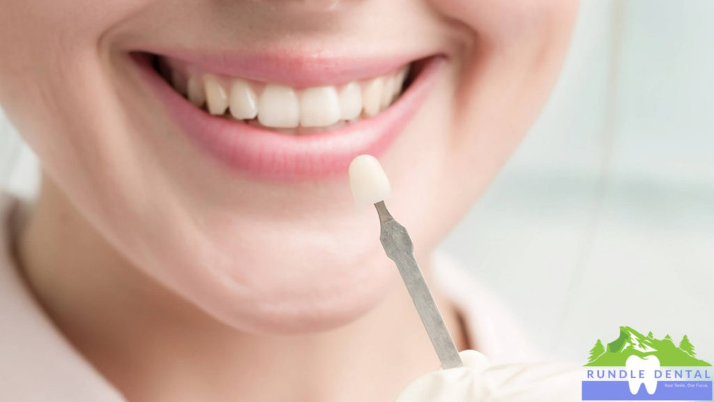 A smile being colored match for dental crowns.